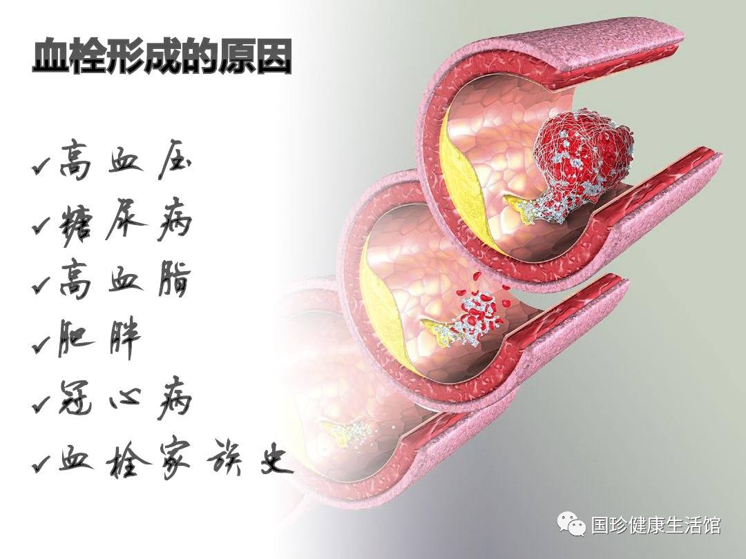 血栓最新研究進(jìn)展，預(yù)防與治療未來方向探索