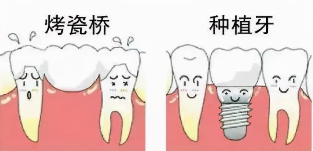 缺一顆種植牙時，如何選擇合適的牙冠數(shù)量？種植牙的選擇與考量指南